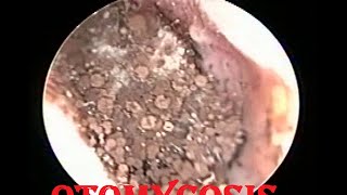 Severe fungal infection  Otomycosis ear cleaning [upl. by Pegeen]