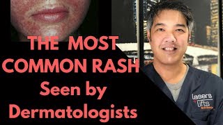 How to treat Perioral Dermatitis Dermatologist Explains [upl. by Vevine155]