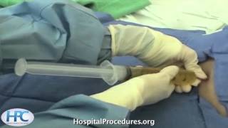 Paracentesis Procedure Video Trailer [upl. by Ixel]