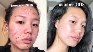 Acne Skincare Routine FINALLY [upl. by Gnak]