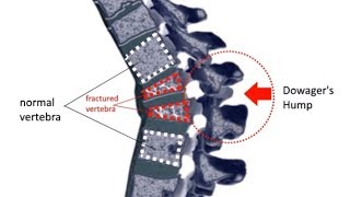 Neck Hump Buffalo Hump Dowagers Hump explained [upl. by Nwahsyd]