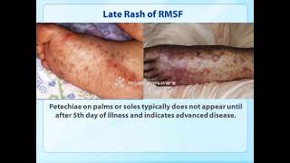 Rocky Mountain spotted fever RMSF Clinical Training [upl. by Saideman]