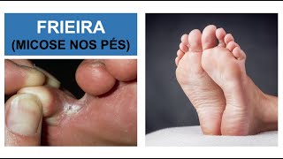 MICOSE NOS PÉS Frieira  Como combater Por Luiz Gameiro dermatologista [upl. by Haliehs978]