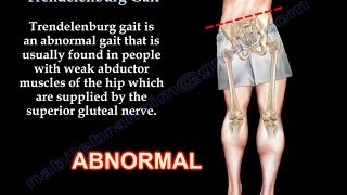 Trendelenburg Gait  Everything You Need To Know  Dr Nabil Ebraheim [upl. by Aeriela550]