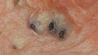 old blackheads extraction compilation [upl. by Lydnek92]