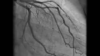 Coronary Angiography  NEJM [upl. by Nenney]