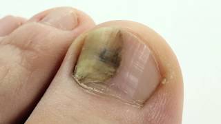 Tolnaftate for Toenail Fungus [upl. by Quintin282]