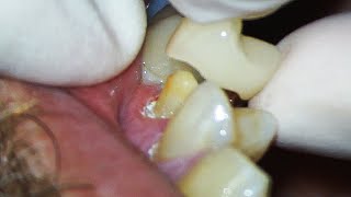 Dental Crown EXPLAINED and how much Tooth Youll Lose [upl. by Cahra]