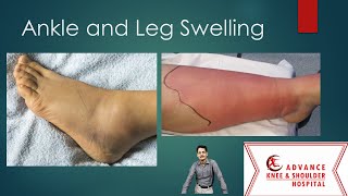 Top 10 causes of Ankle and Leg Swelling [upl. by Artim7]