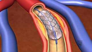 Angiography Procedure by Dr Siddhant Jain Indore [upl. by Cedric]