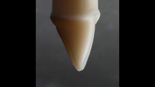 All Ceramic Crown Preparation for Emax and Zirconia [upl. by Sylvie]