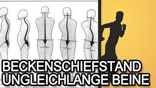 Beckenschiefstand und ungleichlange Beine  Ursache amp Symptome [upl. by Zarla152]