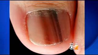 Doctors Warn Of Potentiall Deadly Form Of Nail Cancer [upl. by Hertzog]