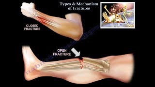 Types amp Mechanism Of Fractures  Everything You Need To Know  Dr Nabil Ebraheim [upl. by Lat]