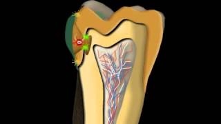 Dental Caries Treatment [upl. by Chaim]