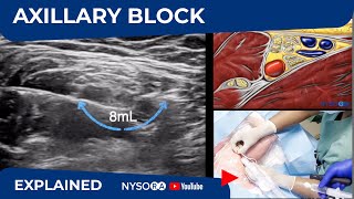 Ultrasound Guided Axillary Brachial Plexus Block NYSORA Regional Anesthesia [upl. by Nyahs]