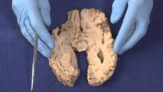 Basal Ganglia Neuroanatomy Video Lab  Brain Dissections [upl. by Ajay]