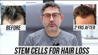 STEM CELL Hair Restorations 2 Year Updates Multiple Patient Success Stories [upl. by Saunder]