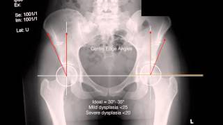 dysplasia xrays [upl. by Leaj325]