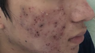 Blackheads Removal 332b  Loan Nguyen [upl. by Notsniw]