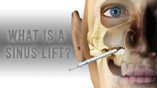 What is a sinus lift [upl. by Margo]