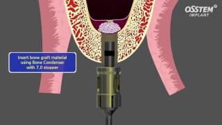 Internal Sinus Lift [upl. by Haletky]