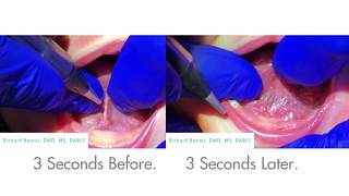 Ankyloglossia  Tongue tie release surgery [upl. by Temp]