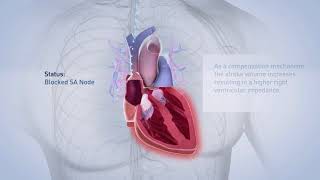 Biotronik pacemaker [upl. by Arbrab]