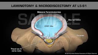 Laminotomy amp Microdiscectomy at L5S1 [upl. by Annovahs234]