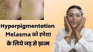 Magical Remedy for Hyperpigmentation Melasma  Pigmentation treatment at Home  Dr Upasana Vohra [upl. by Sexton]