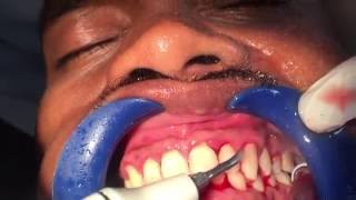 Dental Office Professional Ultrasonic Teeth Cleaning Removing Tartar amp Dental calculus [upl. by Rajewski]