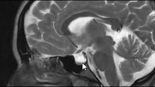 Pseudotumor Cerebri  Brain Scan MRI [upl. by Tatum]