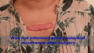 Chest Keloids  Mistakes to Avoid [upl. by Nohs745]