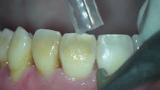 Biofilm stains and young calculus removal from teeth [upl. by Rehteh]