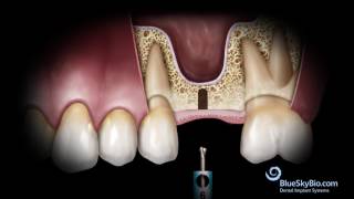 Basic Hammerless Sinus Lift Instrument Technique [upl. by Viking]