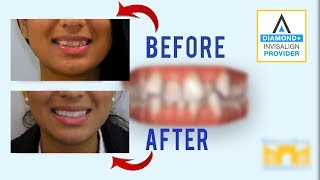 Invisalign Before and After Crowded Teeth [upl. by Eniamrehs143]