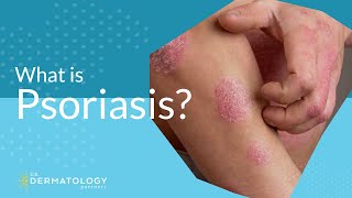 What Is Psoriasis [upl. by Prouty648]