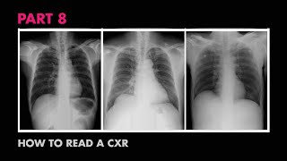 Diaphragms and Pleural Effusion  How to Read a Chest XRay Part 8  MEDZCOOL [upl. by Sakmar]