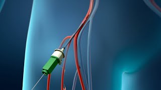 Angioplasty Procedure Animation Video [upl. by Sanfo]