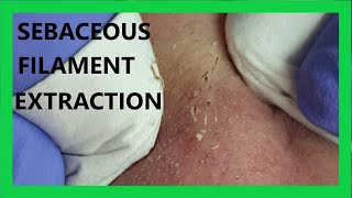 Sebaceous FILAMENT Extraction [upl. by Ierna]