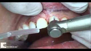 Preparation Six Maxillary Anterior Veneers by Dr Ed McLaren [upl. by Epifano]