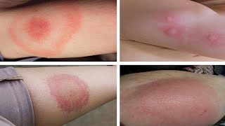 How to Get Rid Of Mosquito Bites Overnight [upl. by Atinna677]