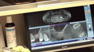 EXPLICIT  Internal Sinus lift  Osteotome technique  Dental Surgery [upl. by Ettenaej82]