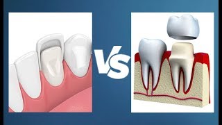 Veneers vs Crowns  Whats the Difference [upl. by Firehs342]