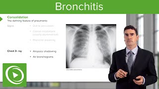 Bronchitis Treatment Options [upl. by Adnahsor401]