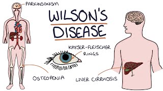 Understanding Wilsons Disease [upl. by Euqinamod]