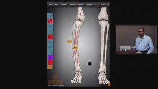 Osteotomy Rules [upl. by Gerrilee]