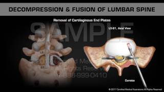 Decompression amp Fusion of Lumbar Spine [upl. by Ledda]