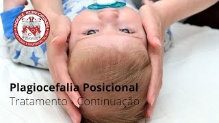 Plagiocefalia Posicional  TRATAMENTO CONTINUAÇÃO  Dr Diogo Neurocirurgião [upl. by Galanti362]