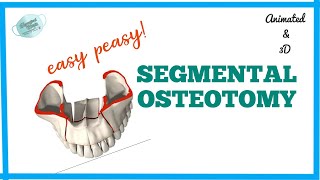 SEGMENTAL OSTEOTOMY  MAXILLARY OSTEOTOMY [upl. by Ileek]